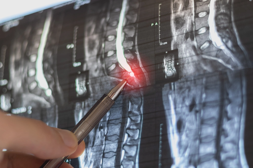 Understanding Spinal Cord Injuries
